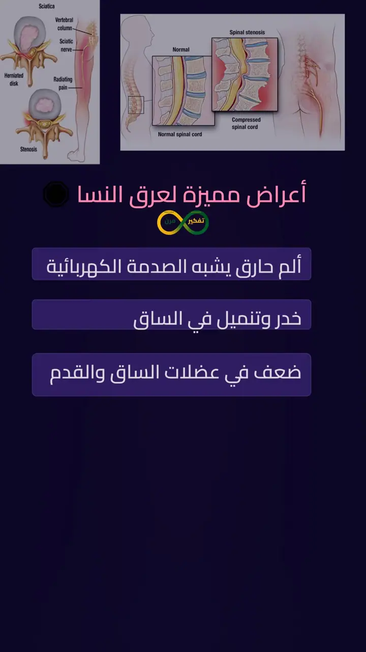 الشريحة 5 من 12: متلازمة عصب وركي وعرق نساء