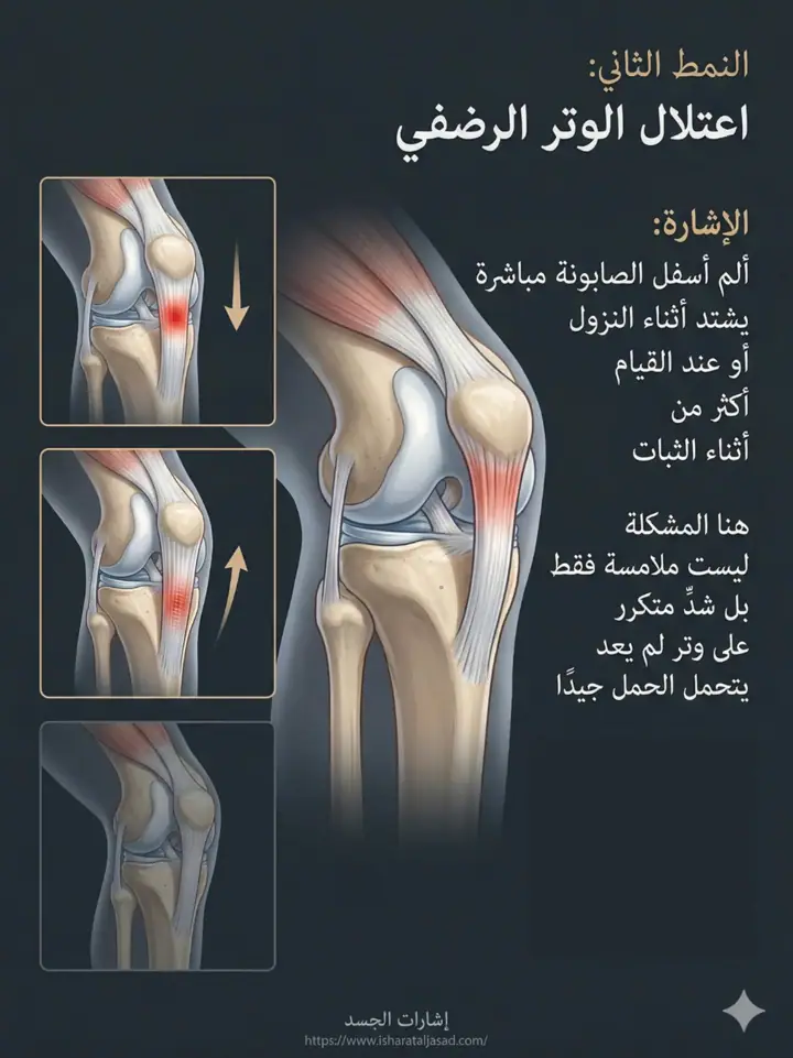 الشريحة 8 من 20: ألم ما تحت الركبة