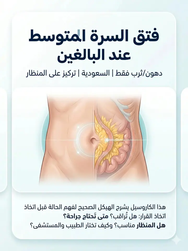 الشريحة 1 من 18: فتق السرة المتوسط عند البالغين