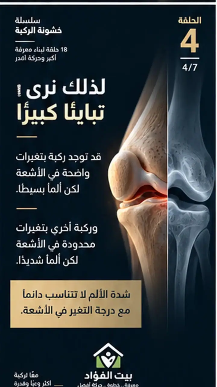 الشريحة 4 من 7: الألم في خشونة الركبة